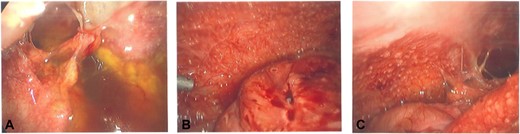 (A–C) intra-operative photos demonstrating reactive ascites, yellow peritoneal nodules, and thickened bowel loops.