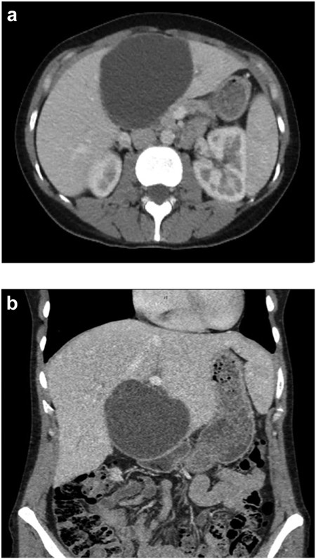 (a) Axial CT abdomen of a septated 10 × 7 cm cystic liver neoplasm. (b) Coronal CT abdomen of a duodenal obstruction secondary to a liver mass.