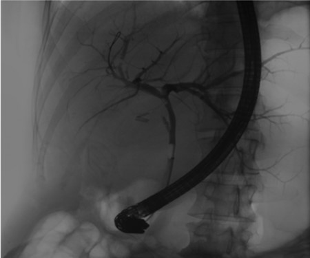 Pre-operative ERCP demonstrating compression of the common hepatic duct.