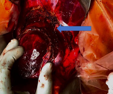 Independent biliary duct (blue arrow) draining to the cyst and not to the liver parenchyma.