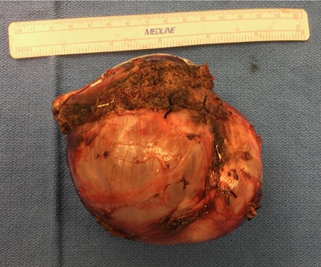 Cystic tumor following resection.