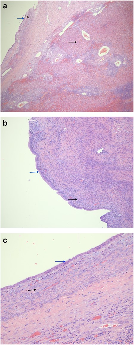 (a) A low power magnification showing a cystic lesion (blue arrow) in a congested and inflamed liver tissue (black arrow). (H&E, 40×). (b) A higher magnification showing the cystic lesion with a columnar mucinous epithelium lacking nuclear atypia (blue arrow); overlying a cellular stroma consisting of ovoid to spindle cell ovarian-type stroma (black arrow) (H&E, 100×). (c) The cystic portion of the lesion has a rather cuboidal lining (blue arrow). The black arrow points the characteristic ovarian storm.