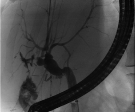 Post-operative ERCP displaying left sided intrahepatic duct biliary dilatation.