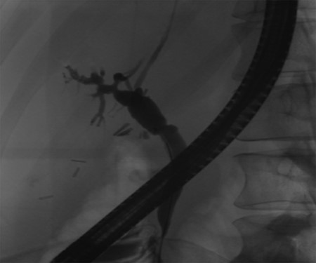 Follow-up ERCP 4 weeks later displaying resolution of all abnormalities.