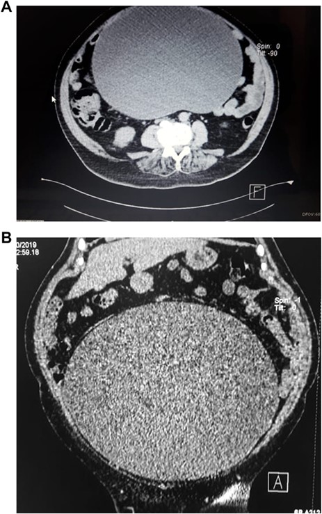 (A) CT scan, show giant cystic mass. (B) CT scan, showing ovarian tumor filling the lower abdomen.