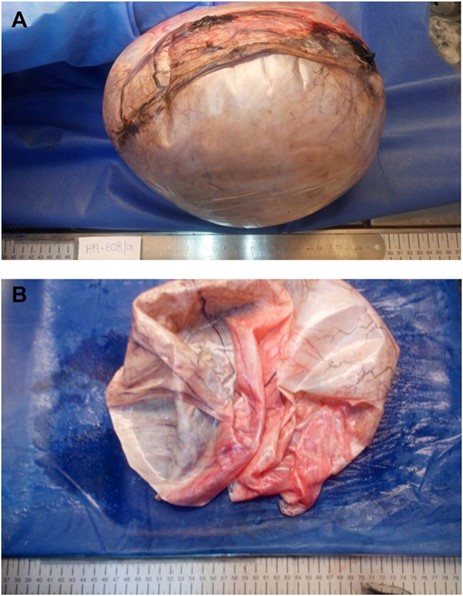 (A) Ovarian mass, its capsule had a whitish color and was covered with dilated blood vessels. (B) Ovarian mass, the tumor had 1000 cc clear fluid.