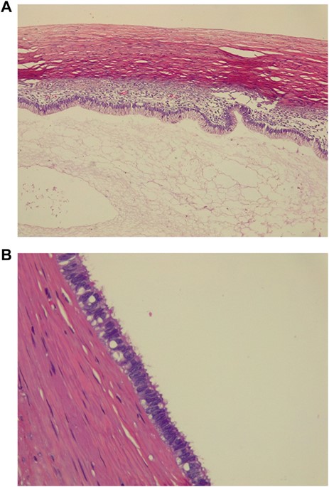 (A) Pathology, tumor is lined with nonciliated, mucin-secreting, columnar epithelium with goblet cells. (C) Pathology, ovarian mucinous cystadenoma without atypia.