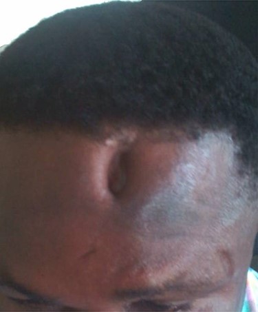 A 43 year-old man who presented with depressed forehead scar following frontal sinusitis. After the sinusectomy, the depressed frontal scar developed.