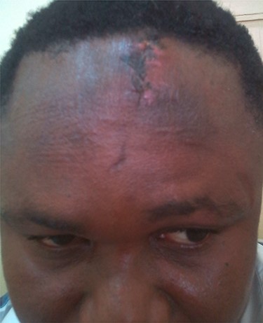 Day 3 post-operative outcome following the debridement of the scar and filling the area with polymethylmethacrylate bone cement and covering it with skin flaps.