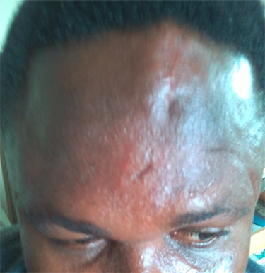 A Post-operative outcome at 18 months of follow-up visit showing the filling of the depression and smothering of the forehead.