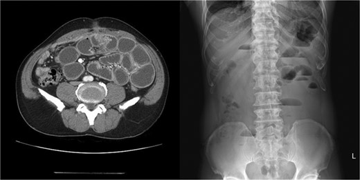 Abdomen CT and X-ray showed adhesions at the periumbilical area with dilated small bowel.