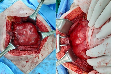 Whole small intestine is encapsulated in a dense fibrous membrane.