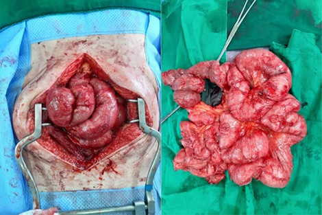 After excision of the membrane off the intestinal surface and complete enterolysis.