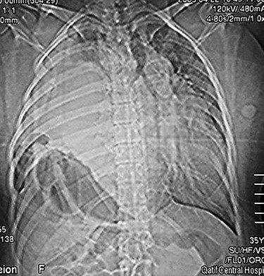 Chest x-ray (on arrival) showing a homogeneous opacity (the liver) occupying the right hemi-thorax with some bowel loops the right hemi-thorax with obvious mediastinal shift to the left side.