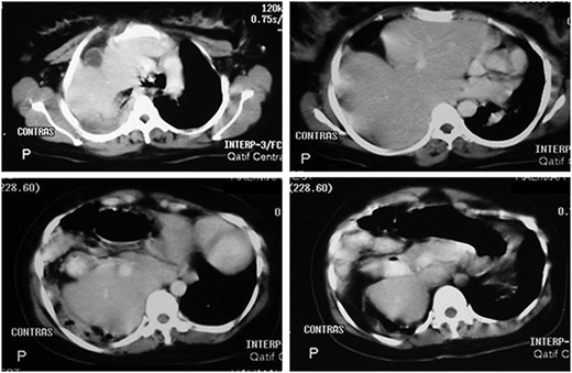 Abdominal CT scan with contrast showing the entire liver and some bowel loops occupying the right hemi-thorax.