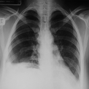 A post-operative chest x-ray showing full inflation of the right lung.