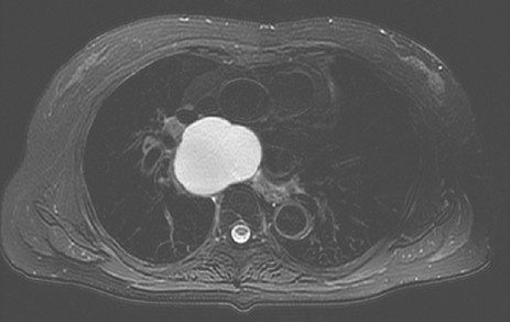 T2 weighted image showing a subcarinal cyst compressing the surrounding organs.