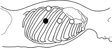 The patient position and port insertion sites; three 5-mm ports (open circles) and one 12-mm port (filled circle) were placed.