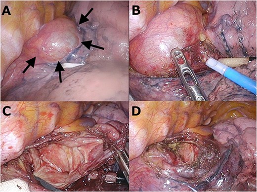 Operative view in the prone position. A: The cyst wall strictly adhered to the surrounding organs (arrows). B: An attempt of a complete resection resulted in lung injury due to the severe adhesions. C: Opening the cyst wall to adequately drain the cavity space. D: After removing a large proportion of the wall, the remnant luminal epithelium was ablated by electrocautery.