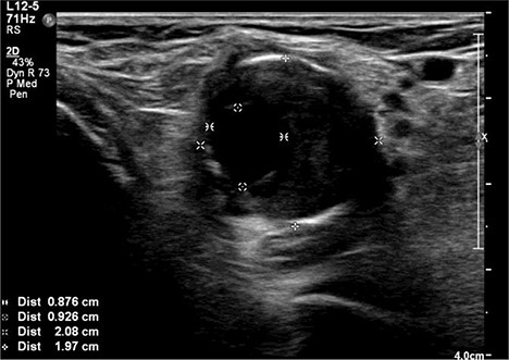 Ultrasound image of left popliteal artery aneurysm containing intramural thrombus, measuring 21 × 20 mm.