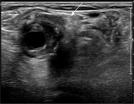 Ultrasound image of left popliteal artery aneurysm, causing displacement and impingement of the common peroneal nerve (indicated by the white arrow).