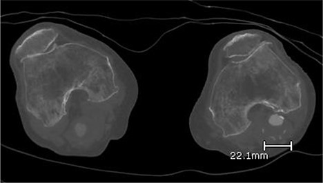 Computed topography angiogram image of left popliteal artery aneurysm, measuring 21 × 22 mm (AP × RL).