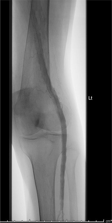 Digital subtraction angiogram image of the endovascular repair of left popliteal artery aneurysm with 8 mm × 15 cm and 7 mm × 10 cm Gore Viabahn stents.