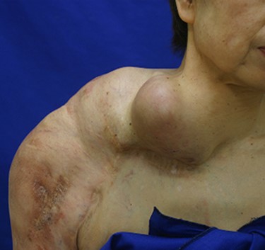 Arteriovenous malformation (AVM) in the right upper limb reaches to the shoulder.