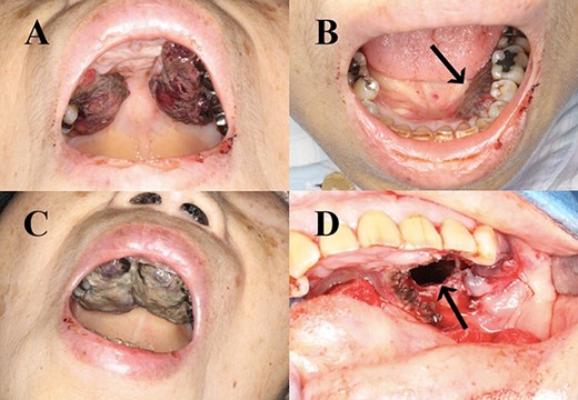 Haemorrhagic masses in the oral cavity. These were identified on the hard palate (A) and the left lower gingiva (arrow) (B). Two weeks after initial presentation (C). Spreading to the upper gingiva, maxillary bone and maxillary sinus (arrow; after resection) (D).