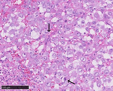 Atypical proliferation of dedifferentiated cells with pleomorphic nuclei and atypical mitotic figures (arrows, haematoxylin–eosin stain, ×400).