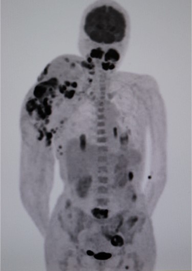 Positron emission tomography–computed tomography (PET-CT). High fluorodeoxyglucose (FDG) accumulation in the oral cavity as well as in the right shoulder where the AVM was located. High accumulation was also evident in the left lung, lumbar spine, piriformis and lymph nodes.