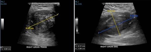 Ultrasound of the right groin showing 6.3 × 4.0 × 4.9 cm hematoma.