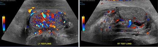 Right testicle is heterogeneous in texture and demonstrates relatively attenuated vascular flow compared to the left.