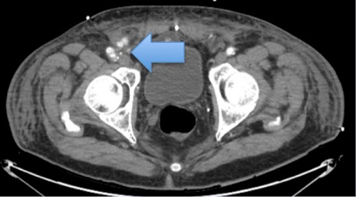 Pseudo-aneurysm from right CFA that extends obliquely measuring up to 2.5 × 1.4 cm. The pseudo-aneurysm appears to extend into the right inguinal canal, filled with hemorrhage extending into the inferior aspect of the right scrotum as well.