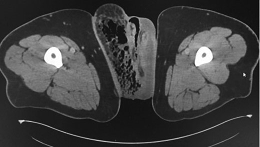 Axial CT scans of pelvic region demonstrating gas in the right groin region.