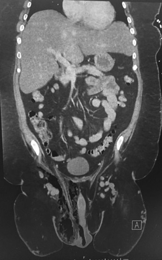 Coronal CT scans of abdominopelvic region demonstrating gas and in the right groin region.