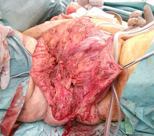Pelvic and perineal region post-surgical debridement.