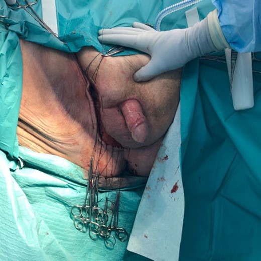 Post application of Artiss with pre-prepared hand ties.