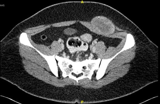 Computed tomography (CT) of abdomen showed well defined heterogenous enhancing soft tissue mass at left lower anterior abdominal wall. The mass has good plane of demarcation with the adjacent external and internal oblique muscle. Poor fat plane between the mass and left rectus abdominis and left transversus abdominis muscle.