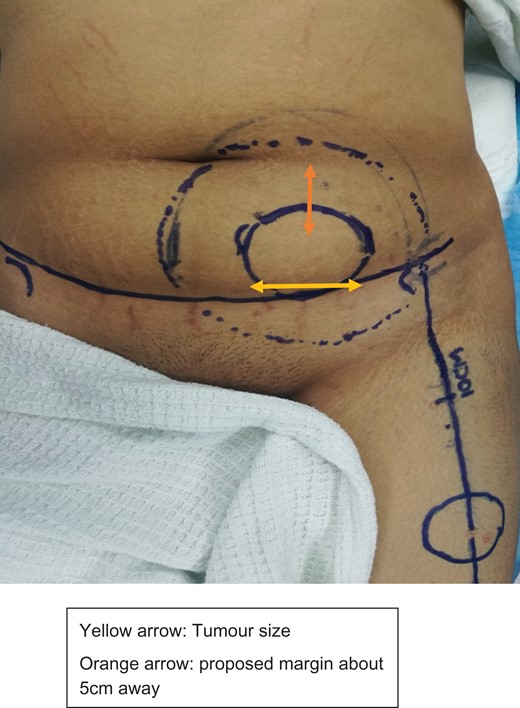 Marking of incision abdominal flap, tumour with 5 cm margin, and donor flap.