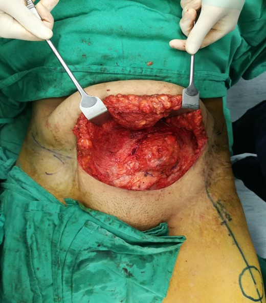 Abdominal flap raised, exposing the tumour.