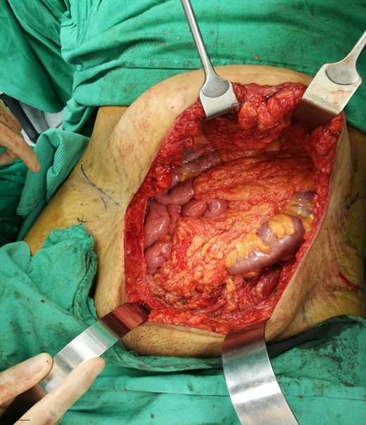 Tumour was excised with 5 cm margin together with underlying peritoneum. It left ~25 Ă— 20 cm2 defect over anterior abdominal wall, exposing the omentum and bowels.