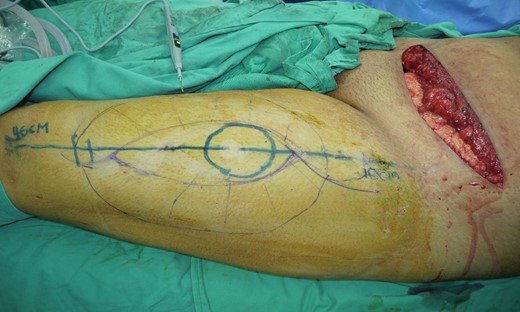 Marking outline for left anterolateral thigh flap donor site for reconstruction.
