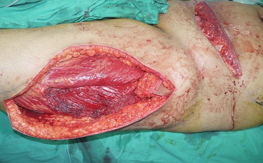 Harvested left pedicled anterolateral thigh myocutaneous flap with fascia lata. The flap was interpolated under subcutaneous skin bridge to cover fascial defect.