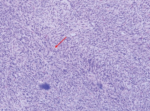 Higher magnification showing herringbone arrangement (arrow) of the malignant spindle cells (H&E, ×100 magnification).