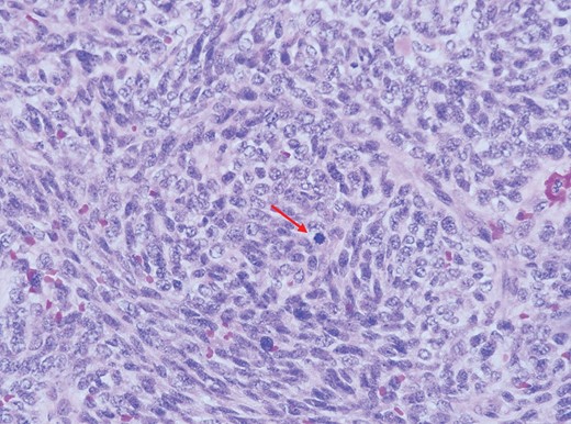 Higher magnification of the malignant spindle cells showing moderate pleomorphism having oval to elongated vesicular to hyperchromatic nuclei, conspicuous nucleoli and minimal eosinophilic cytoplasm. Mitotic figures (arrow) are easily seen (H&E, ×400 magnification).
