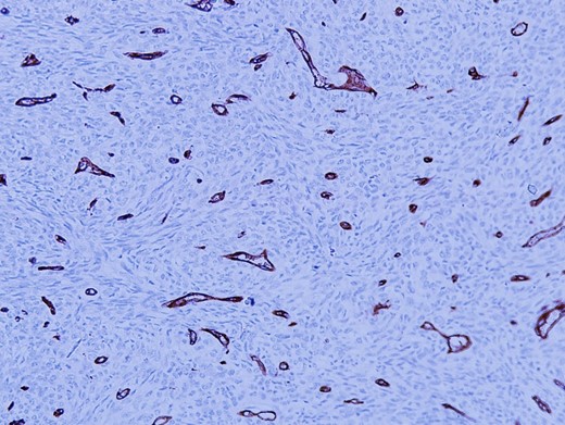 The malignant cells are negative for CD34 immunohistochemistry stain. Only blood vessels are highlighted (H&E, Ă—100 magnification).