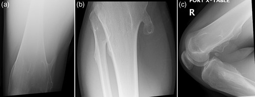 (a–c) Presenting radiographic images with knee locked in flexion.