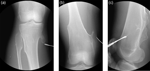 (a–c) Initial intraoperative radiographic images obtained to locate the lesions.