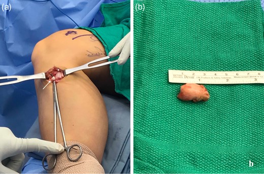 (a) Intraoperative photo demonstrating right medial proximal tibial osteochondroma (distal to *) with incarcerated semitendinosus tendon (arrow, tendon hooked by instrument) inferiorly. (b) Excised right medial proximal tibial osteochondroma.